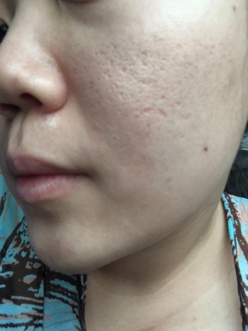 以前长过好多痘痘,留下的痘坑,我不知道我这脸上到底是毛孔粗大还是