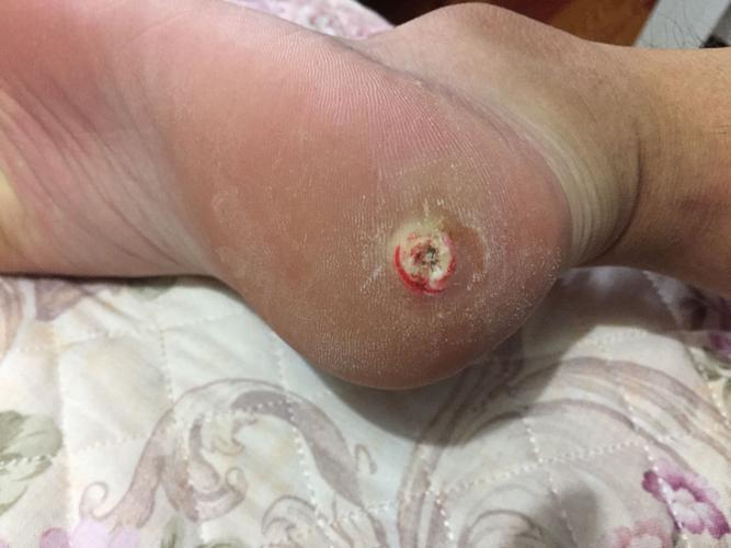 脚后跟长鸡眼 怎么治? 请教各位高人 谢谢了!