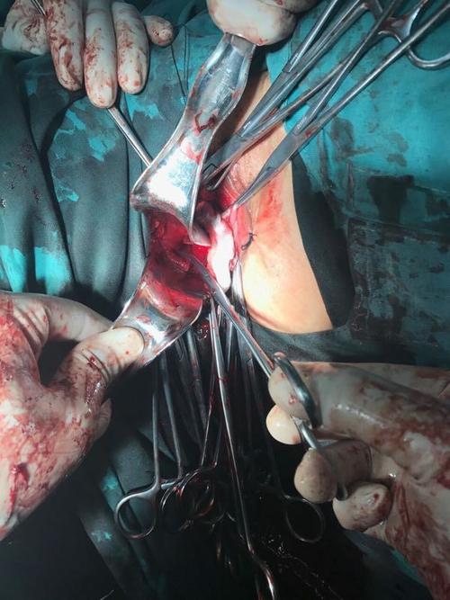 榆林一院病例分享-子宫脱垂行阴式全子宫切除术 阴道残端骶棘韧带悬吊