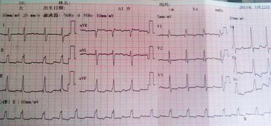 这幅图主导心律房颤应该不错,但qrs起始处好像是delta波,能排除预激