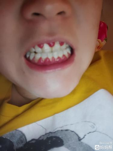 这个牙龈肿痛真的让我很奔溃,还有最后一个