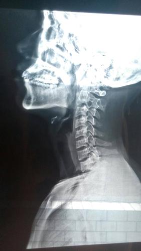 请大家看看我的颈椎问题严重吗