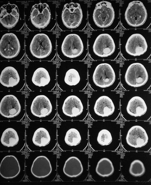 又一例镰旁脑膜瘤