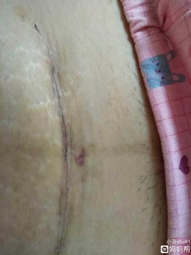剖腹产后的伤口