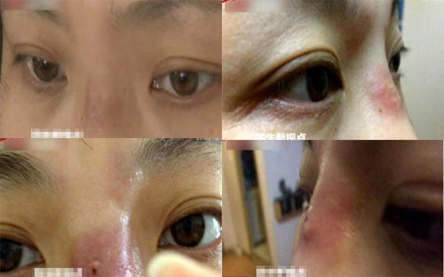 非法玻尿酸美容危害多 隆鼻不成惨毁容