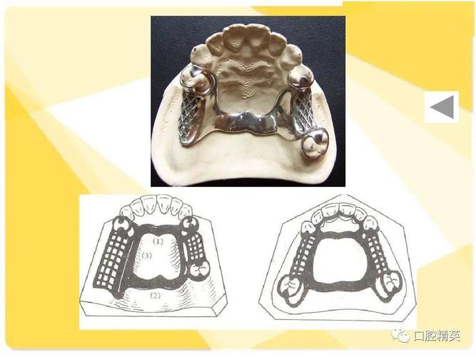 可摘局部义齿-结构