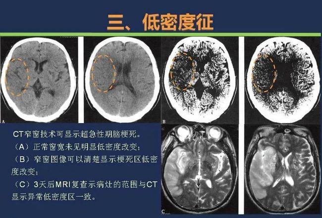 头颅ct如何预判超早期脑梗死