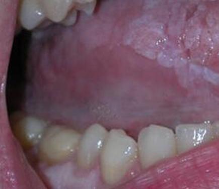 扁平苔藓症状有什么