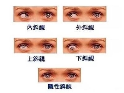 4. 斜视分为以下五种,下列说法正确的是