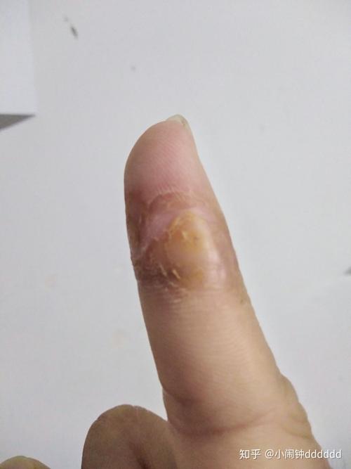 疣长在手指上,虽然不影响用手,也不疼不痒,但严重影响美观,各种折腾