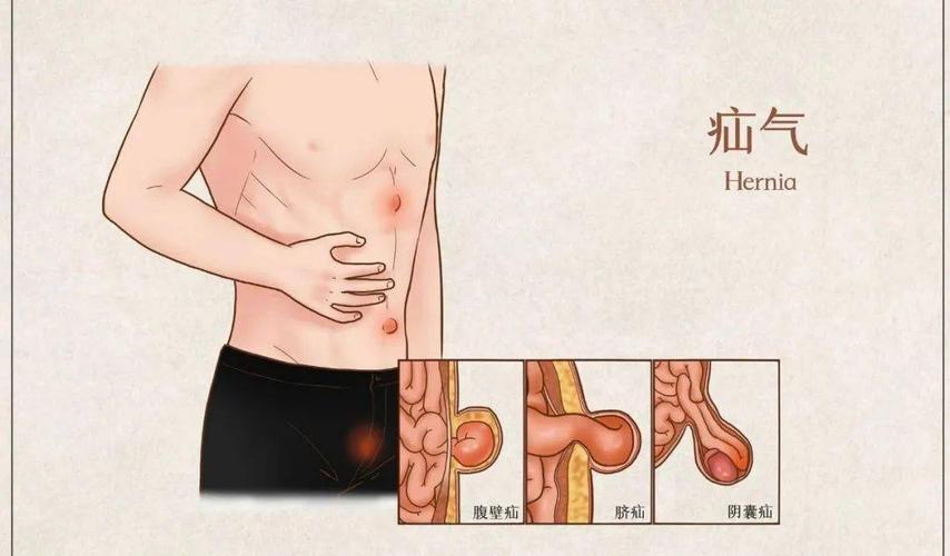 期颐老人患有严重心脏病,腹部肿块突起如鸡蛋,多学科专家勇敢手术成功