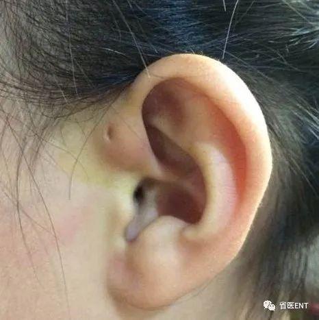 先天性耳前瘘管解剖示意图临床表现:耳前瘘管可以单独发生而不伴有