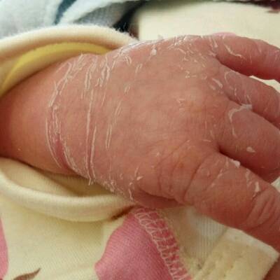 也可能是宝宝小,在蜕皮呢,我宝宝在月子里的时候也蜕皮