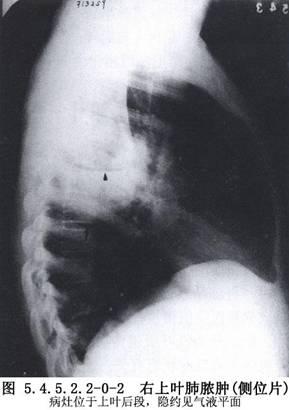 随后咳出脓痰,有时呼出气体有恶臭味.