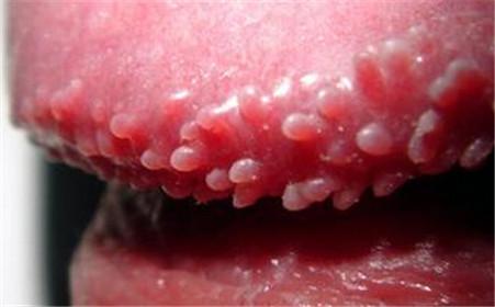 儿童尖锐湿疣治疗应该注意些什么?