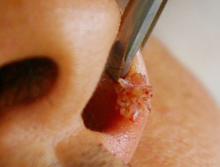 丝状疣的外治法