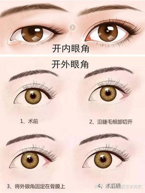 开内眼角与外眼角的关于眼角的那些事