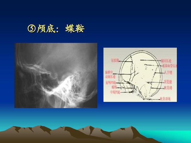 医学影像学课件 ⑤颅底:蝶鞍