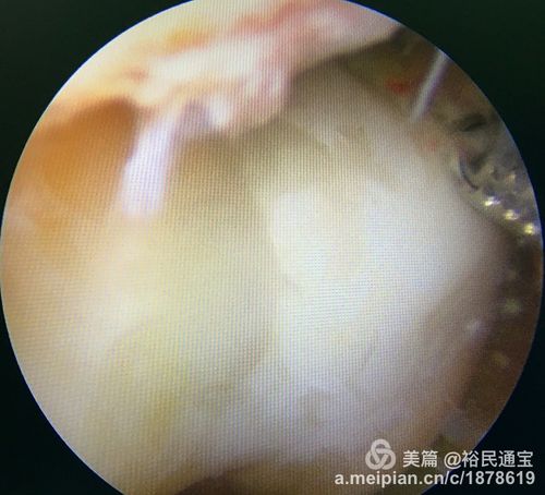 股骨滑车面可见细菌假膜
