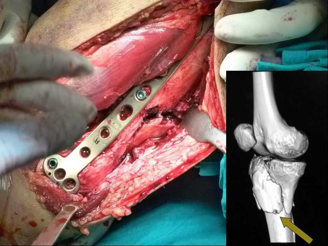 介绍了膝关节的血管解剖,后外侧平台形态学研究(后壁破裂和后壁完整)