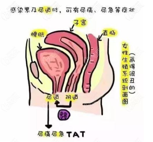 缩阴手术后容易造成阴道感染