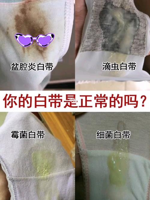你的白带是正常的嘛?赶紧来看看吧_妇科炎症_医疗健康