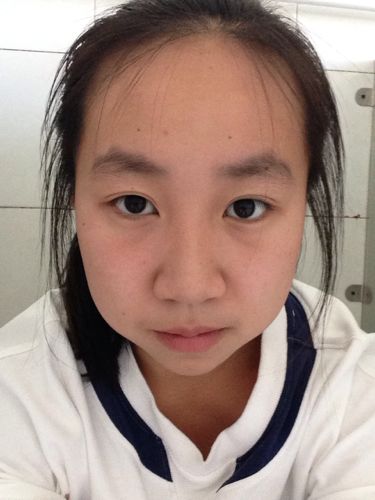 眼睛一大一小怎么办