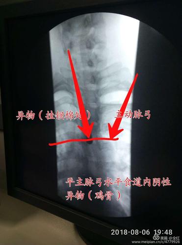 钡餐(吞钡棉)