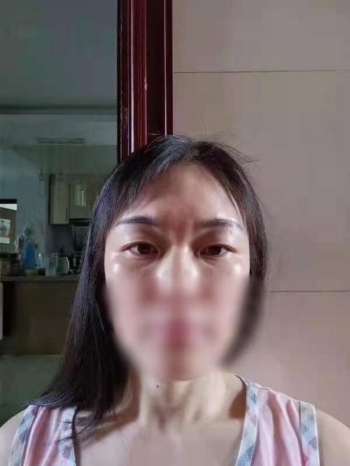玻尿酸打出硬块福华医美陷争执