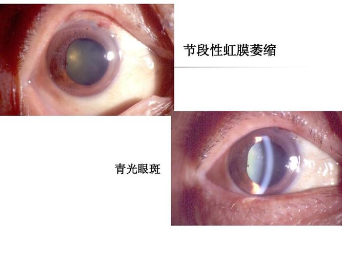 急性闭角型青光眼ppt