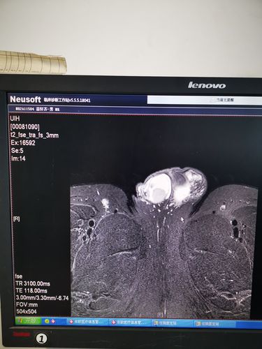 睾丸肿瘤切除术