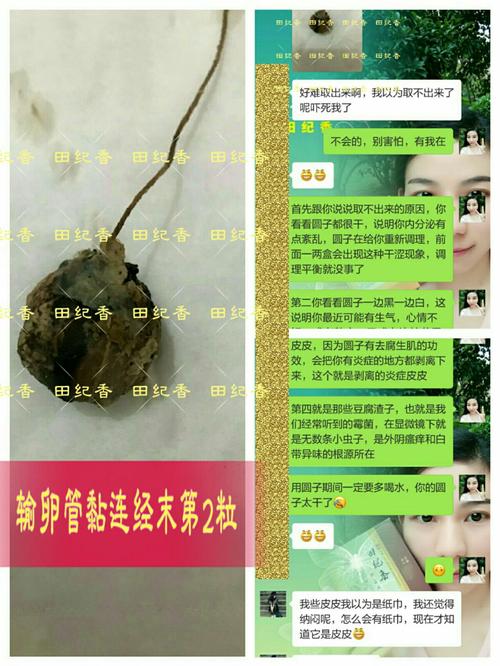 10.4～10.7第2粒经末 毒素大,炎症皮皮,豆腐渣(霉菌),子宫垃圾(黑泥)