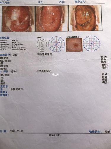 希望hpv tct没事 宫颈糜烂三度可太吓人了 好在慢慢用药今天检查恢复