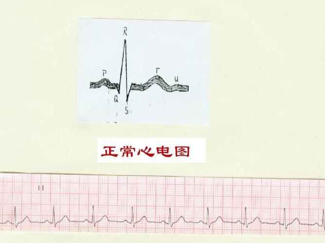 正常心电图
