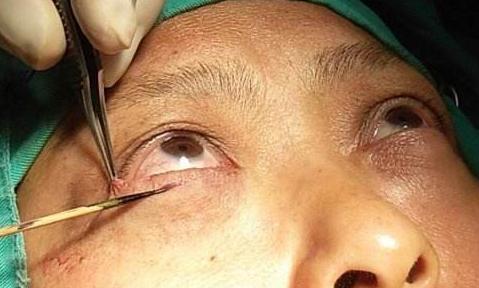 去眼袋手术有哪些注意事项呢