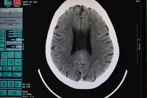 头颅ct看看透明隔