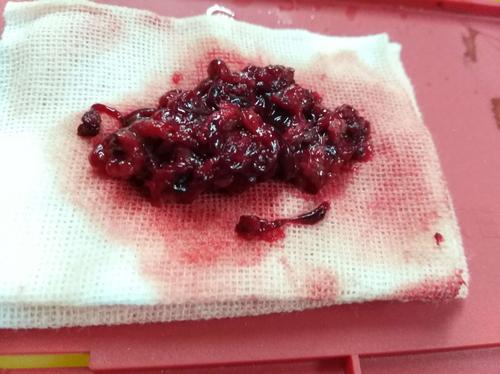 第二次取出来的红色硬化血栓.