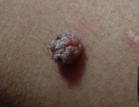 皮肤科的大神请进,手腕上长了一个肉瘤!