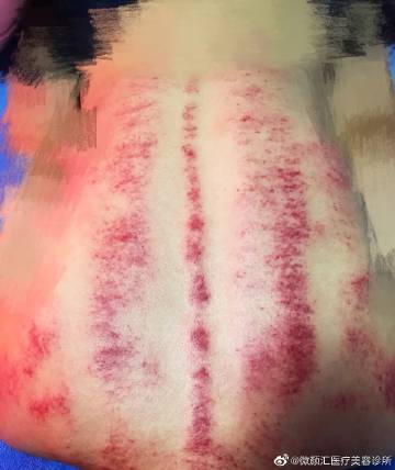 刮疹症状,痴的颜色; 深红色—热症 鲜红色—阳虚火旺 鸟红色—真带