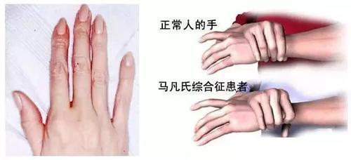 号称"天才病"的马凡氏综合征,究竟是什么?