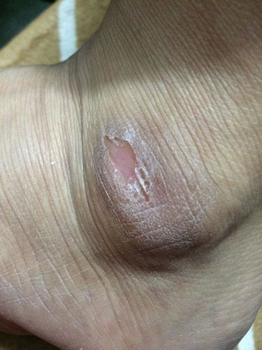 脚踝那里老是有死皮是怎么回事呢 照片里面是已经剪掉