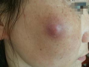 皮脂腺囊肿这类疾病非常容易发生在患者的头部以及面部,出现该类疾病