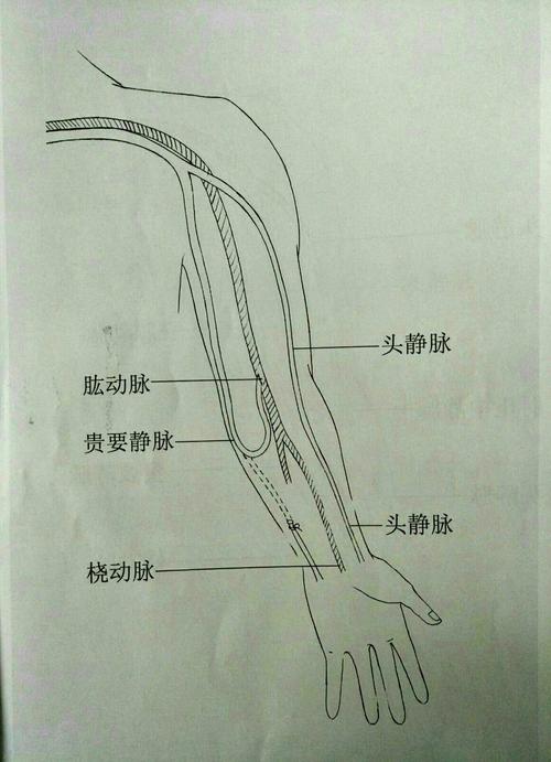 avf 左侧 贵要静脉-肱动脉 吻合(↓)