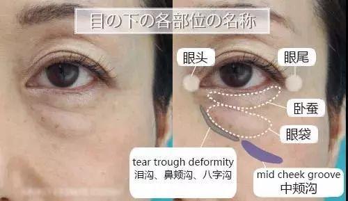 当眼部已经开始衰老松弛后,我们真正的诉求是:提升.