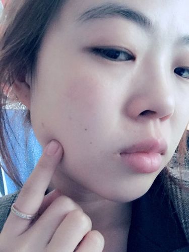 左脸手指处有一个囊肿(黄豆大小的,可以移动,)要手术