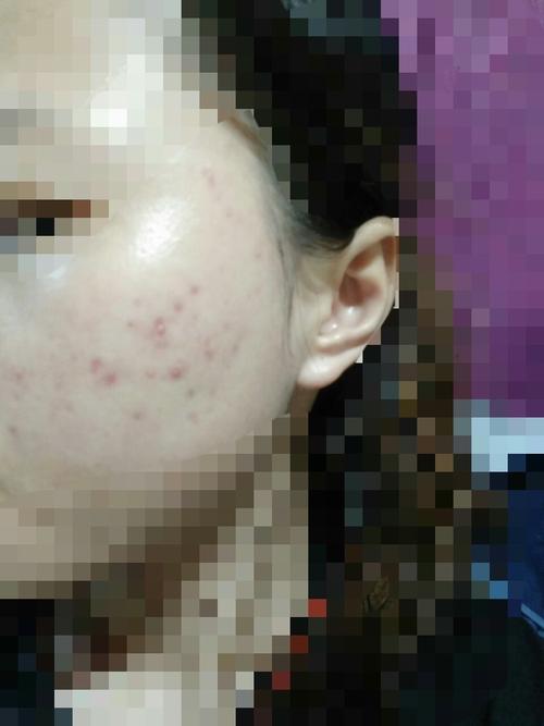 素颜痘印图杜克色修祛痘印红痘印美白淡斑敏感肌油皮