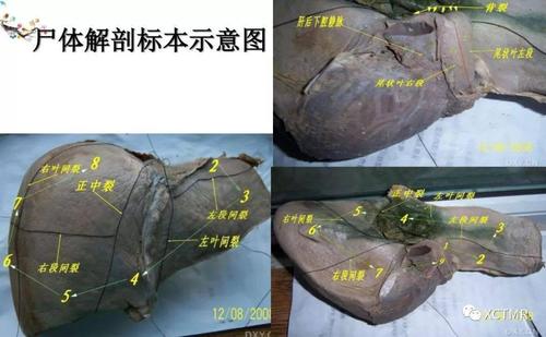 收藏丨肝脏分叶分段的影像解剖
