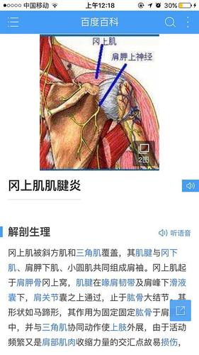 岗上肌肌腱炎