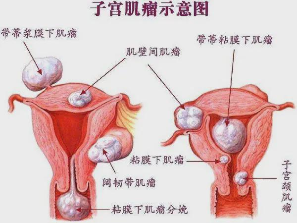 女性子宫肌瘤该慌还是不慌