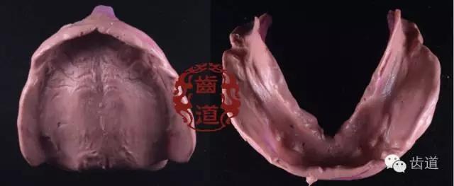 全口之疯飞越巅峰:下颌前磨牙段舌侧骨突重新修复全口